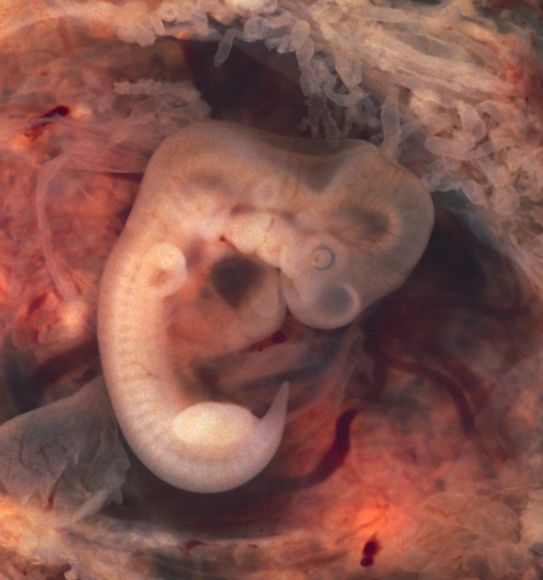 извънматочна бременност, ембрион