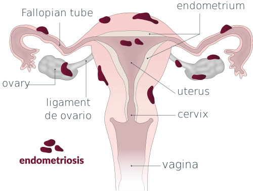ендометриоза