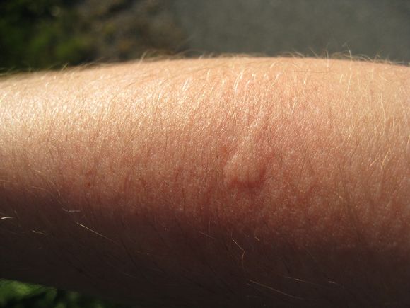 Mosquito bite. Credit: Johan, flickr